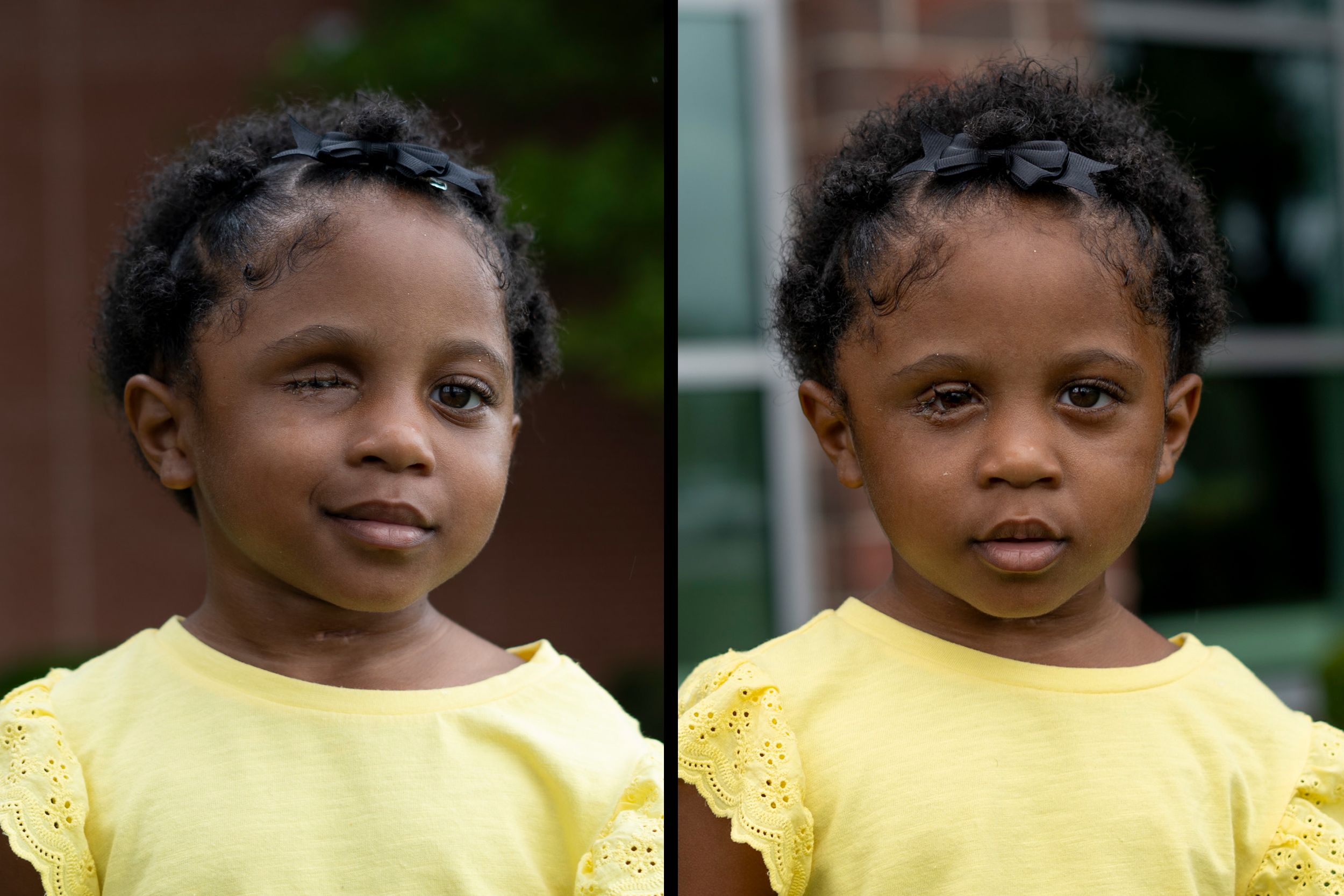 Skye McBride, before and after receiving her prosthetic eye.